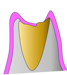 クラウンレングスニング1