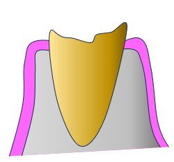 クラウンレングスニング3