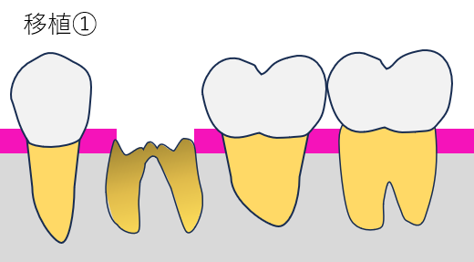 歯牙移植1