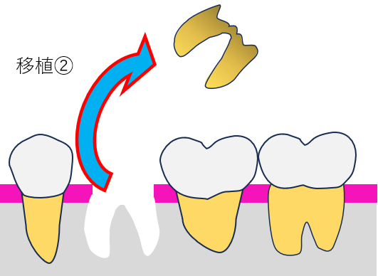 歯牙移植2