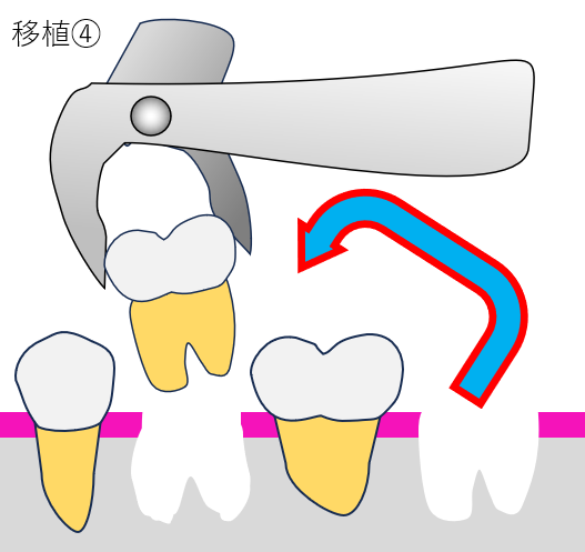 歯牙移植4