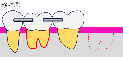 歯牙移植5