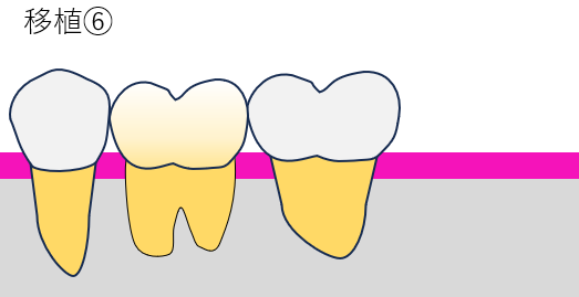 歯牙移植6